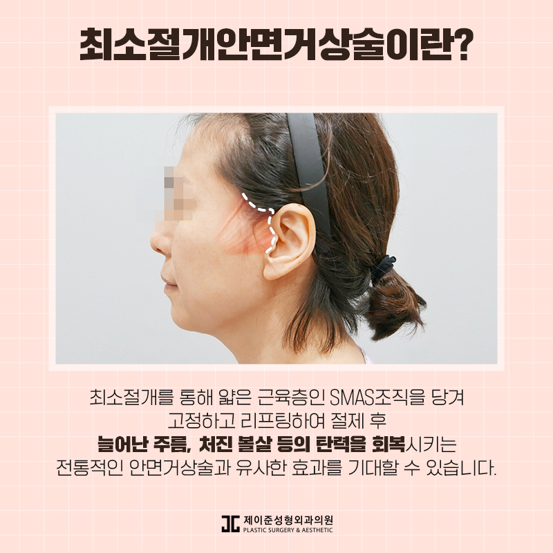 최소절개안면거상술 어떤 수술일까? 관련 이미지 2