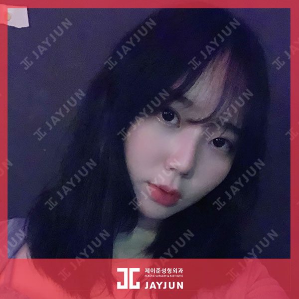 제이준피부과, 강남 입술필러 용량이 무제한이라고?! 관련 이미지 5