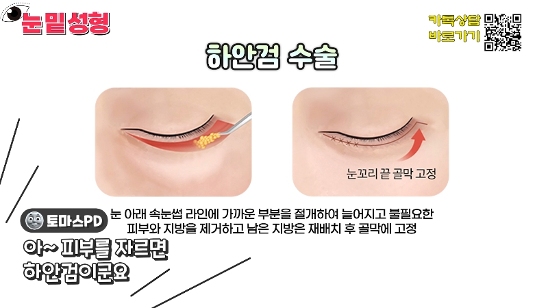 [Jeijun Plastic Surgery & Dermatology&middot;] Lower Blepharoplasty? Lower Eyelid Fat Repositioning? Read This Before Deciding! image 10