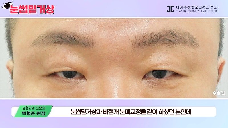 [Jayjun Plastic Surgery & Dermatology] Worried about drooping eyelids? Solve sagging eyes with a brow lift under the eyebrows without double eyelid surgery! image 15