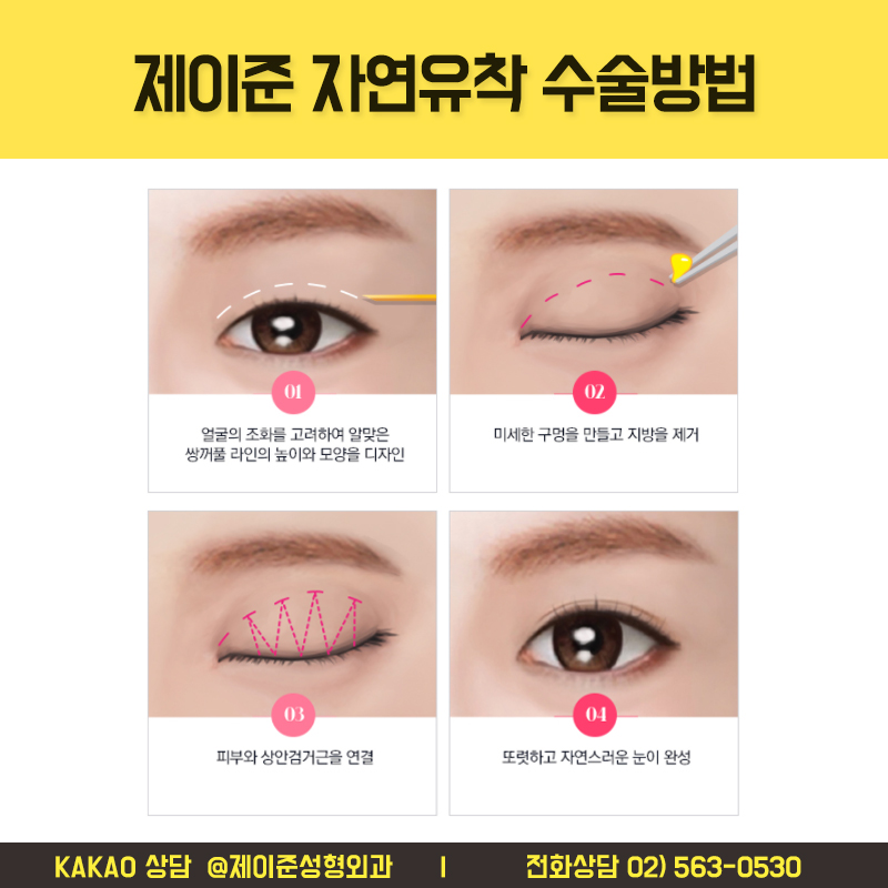 강남역쌍수, 자연유착 할거면 꼭 알아야할 점 관련 이미지 5