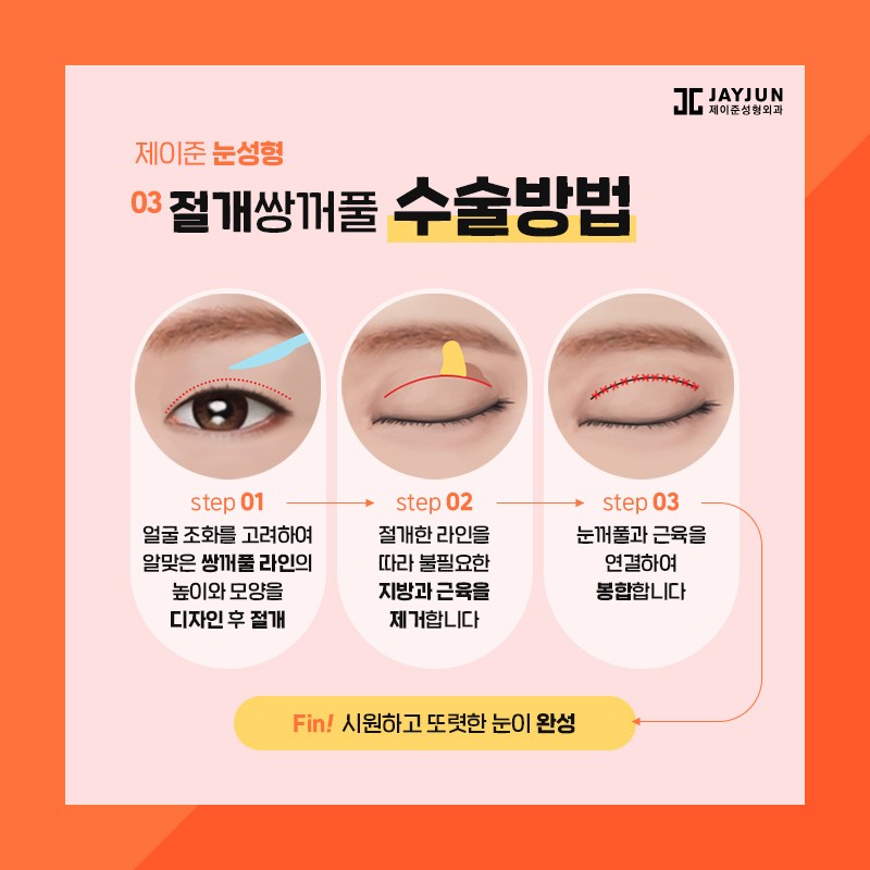 쌍꺼풀수술 종류 알아보기 관련 이미지 7