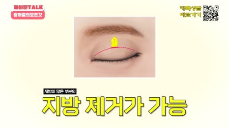 [제이준성형외과&middot;피부과] 비절개&middot;부분절개&middot;절개 쌍꺼풀의 원리와 차이점! 관련 이미지 14