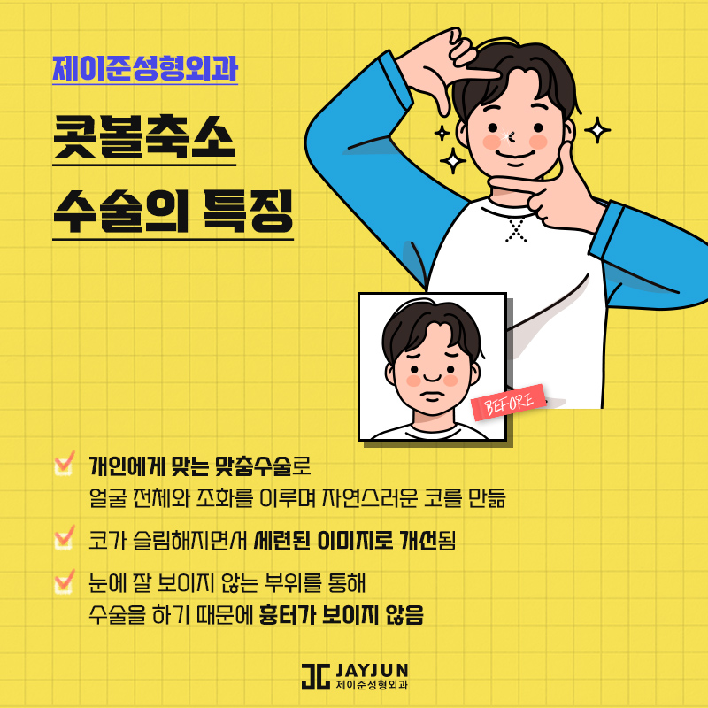 제이준의 비절개콧볼축소 , 콧볼축소 차이점 관련 이미지 8