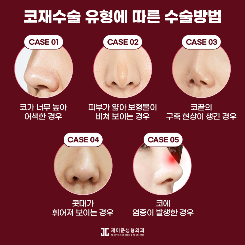 코재수술잘하는곳 , 재수술 성공하려면 원인부터 파악해야 관련 이미지 4