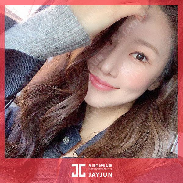 강남역피부과 입꼬리보톡스 + 용량무제한 입술필러 이벤트 한대요!? 관련 이미지 4