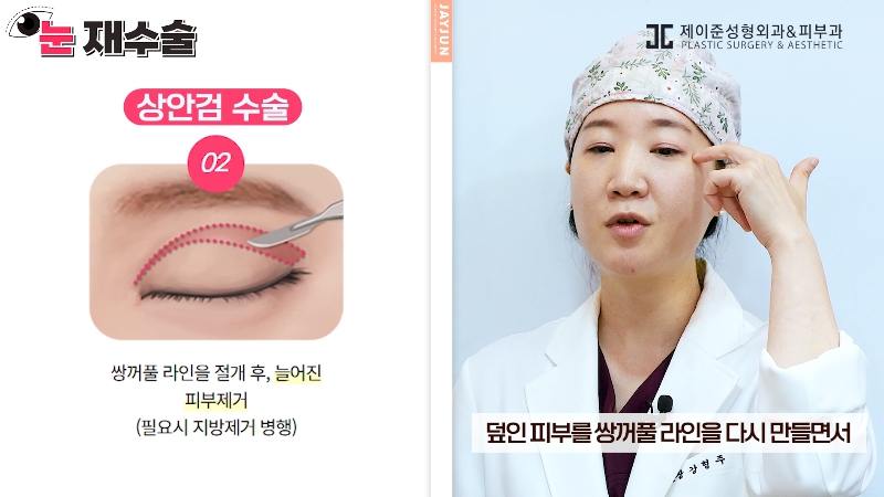 [Jeijun Plastic Surgery &amp; Dermatology] Everything a plastic surgery specialist wants you to know about eyelid revision surgery! Customized methods by case! image 20