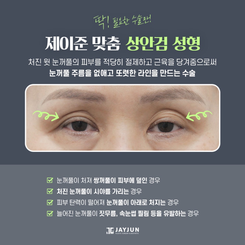 [제이준 성형외과] 미용+기능 동시에 잡는 제이준 중년 눈성형 관련 이미지 3
