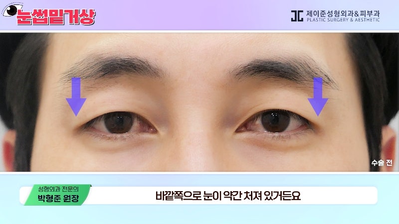 [Jayjun Plastic Surgery & Dermatology] Worried about drooping eyelids? Solve sagging eyes with a brow lift under the eyebrows without double eyelid surgery! image 10