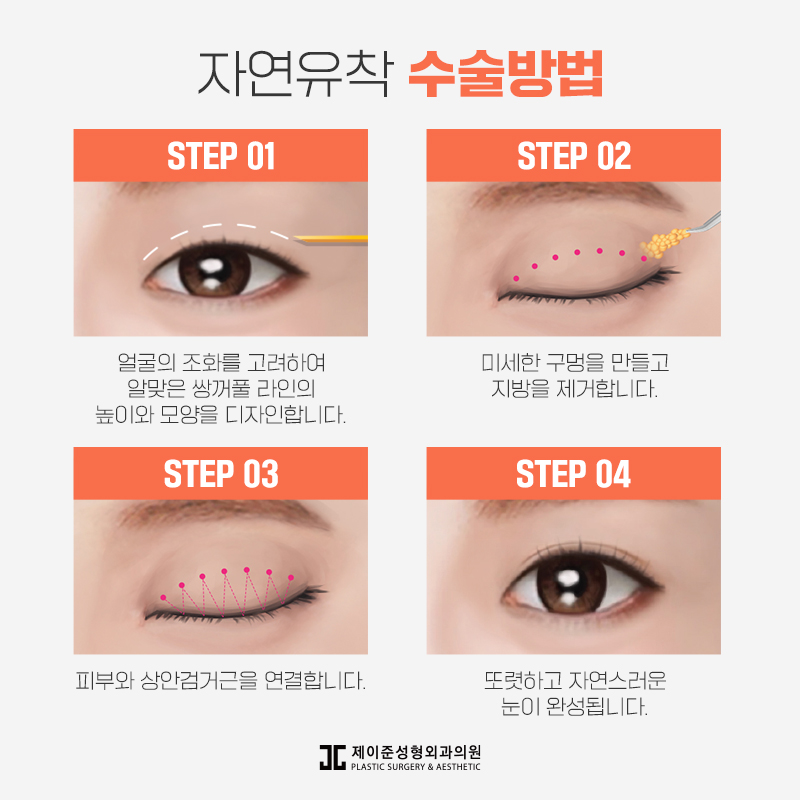 자연스러운 라인을 위한 자연유착 관련 이미지 4