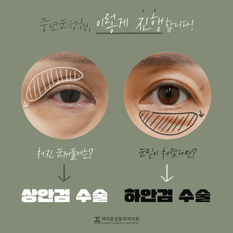 상안검과 하안검이란? 관련 이미지 2
