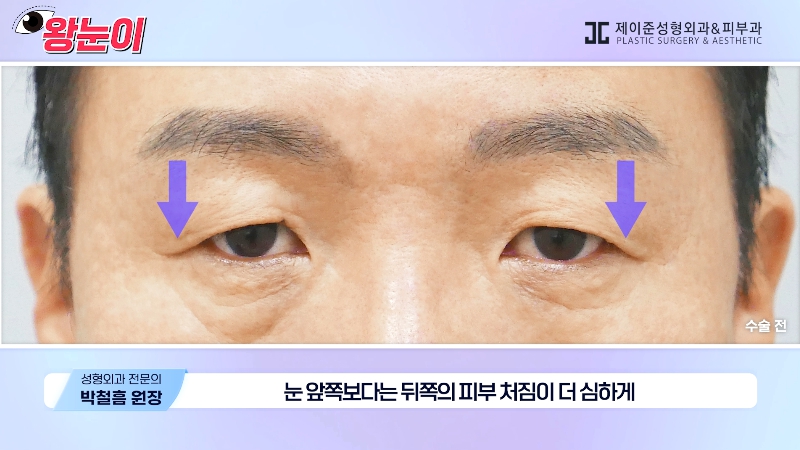 [제이준성형외과&middot;피부과] 제이준성형외과 박철흠 원장님이 알려주는 눈이 커지는 방법 핵심요약! 관련 이미지 17