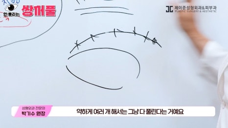 [제이준성형외과&middot;피부과] 쌍꺼풀 수술 vs 쌍꺼풀+눈매교정! 눈매교정 함께 하면 좋은 이유! 관련 이미지 6