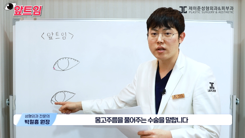 [Jaejune Plastic Surgery & Dermatology] Why is epicanthoplasty necessary? Everything about epicanthoplasty!! image 5