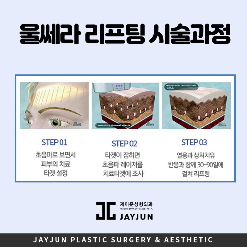강남역 울쎄라 탄력 리프팅 │ 피부 처진 후 붓기 얼마나 가나요? 관련 이미지 5