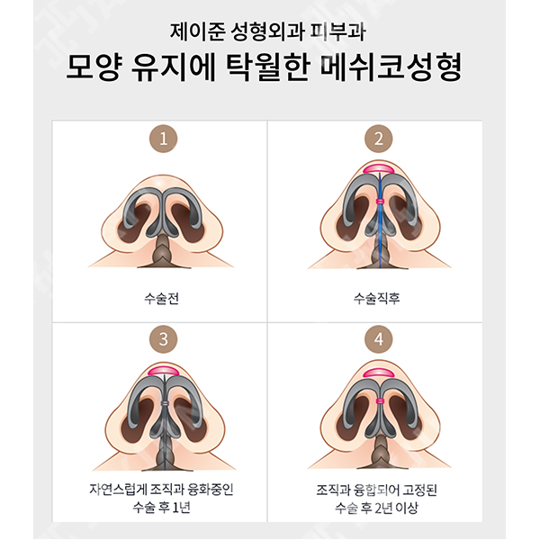 제이준성형외과｜ 자연스러운 관련 이미지 3