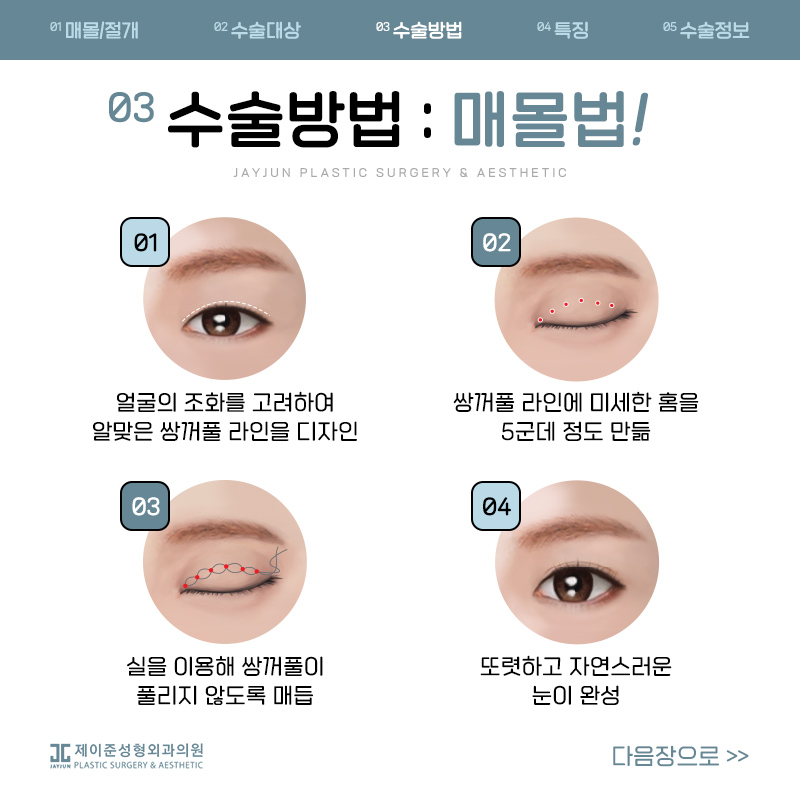 쌍꺼풀수술 매몰과 절개 어떤수술? 관련 이미지 4