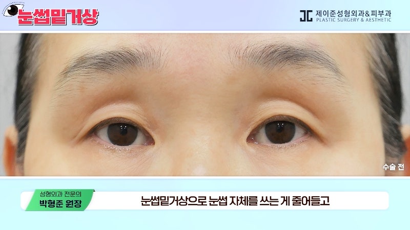 [Jayjun Plastic Surgery & Dermatology] Worried about drooping eyelids? Solve sagging eyes with a brow lift under the eyebrows without double eyelid surgery! image 13