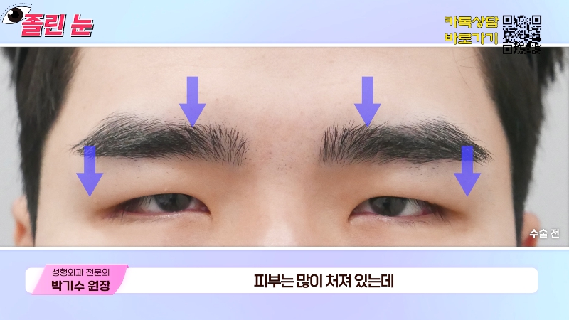 [제이준성형외과&middot;피부과] 졸려보이는 눈과 이마 주름의 상관관계? 관련 이미지 14