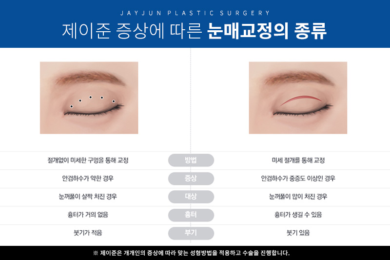 맞춤 눈매교정 눈성형을 원한다면 ? 제이준성형외과에서 ! 관련 이미지 4