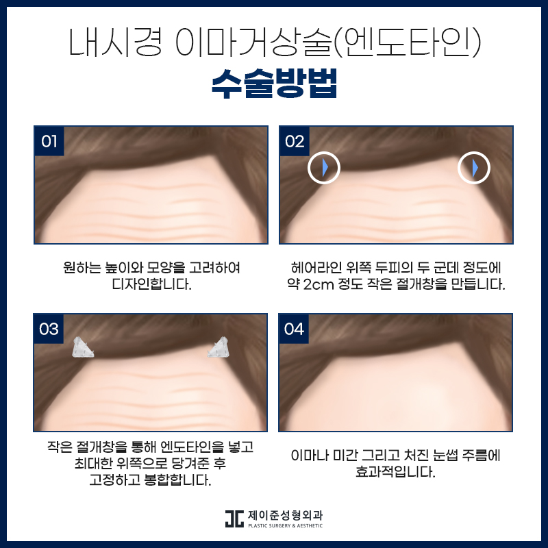 노화증상 개선하고 동안외모로! 엔도타인 이마거상술 관련 이미지 5