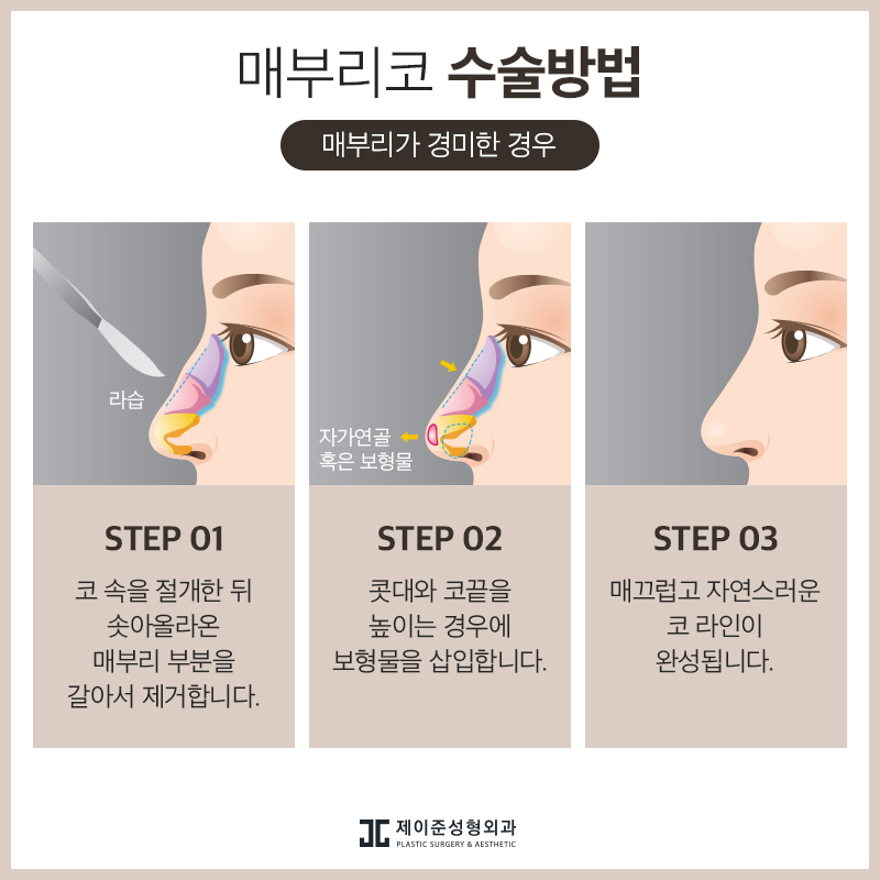 매부리코 교정 , 유형과 상태에 따라 진행돼야 관련 이미지 5