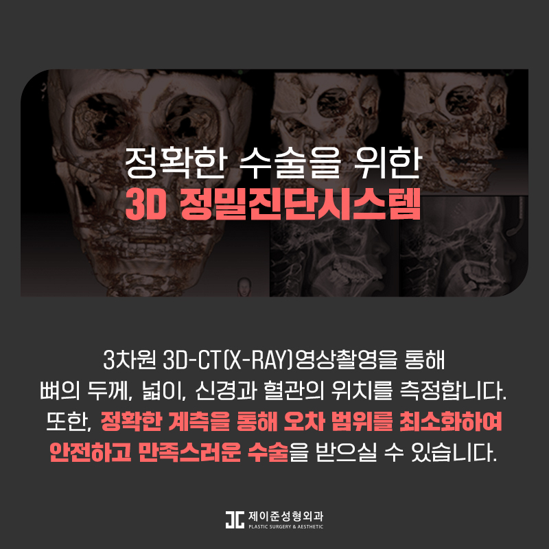 갸름한 얼굴형을 위한 앞턱수술 관련 이미지 8