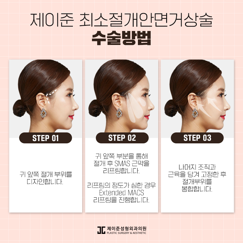 최소절개안면거상술 어떤 수술일까? 관련 이미지 4