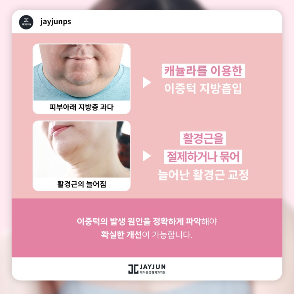 한번에 확실하게! 제이준 이중턱 지방흡입 & 근육묶기 관련 이미지 3