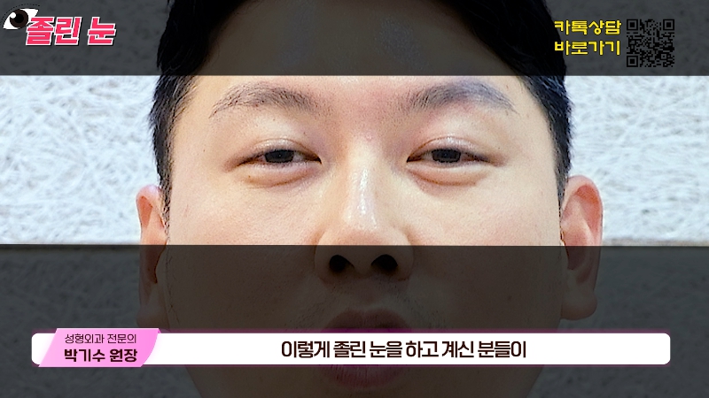 [제이준성형외과&middot;피부과] 졸려보이는 눈과 이마 주름의 상관관계? 관련 이미지 2