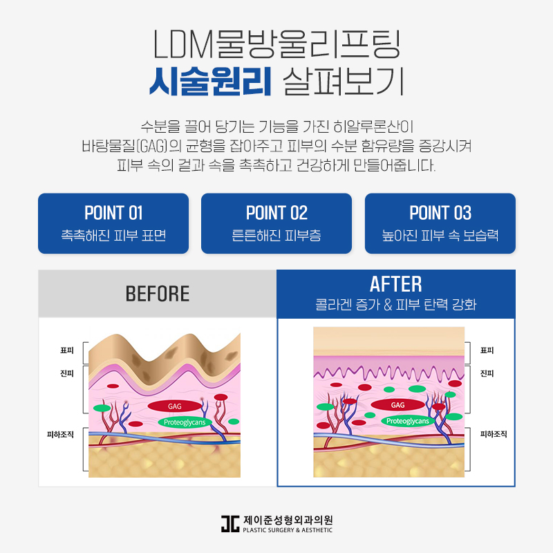 LDM물방울리프팅 , 수분과 탄력을 동시에! 관련 이미지 6
