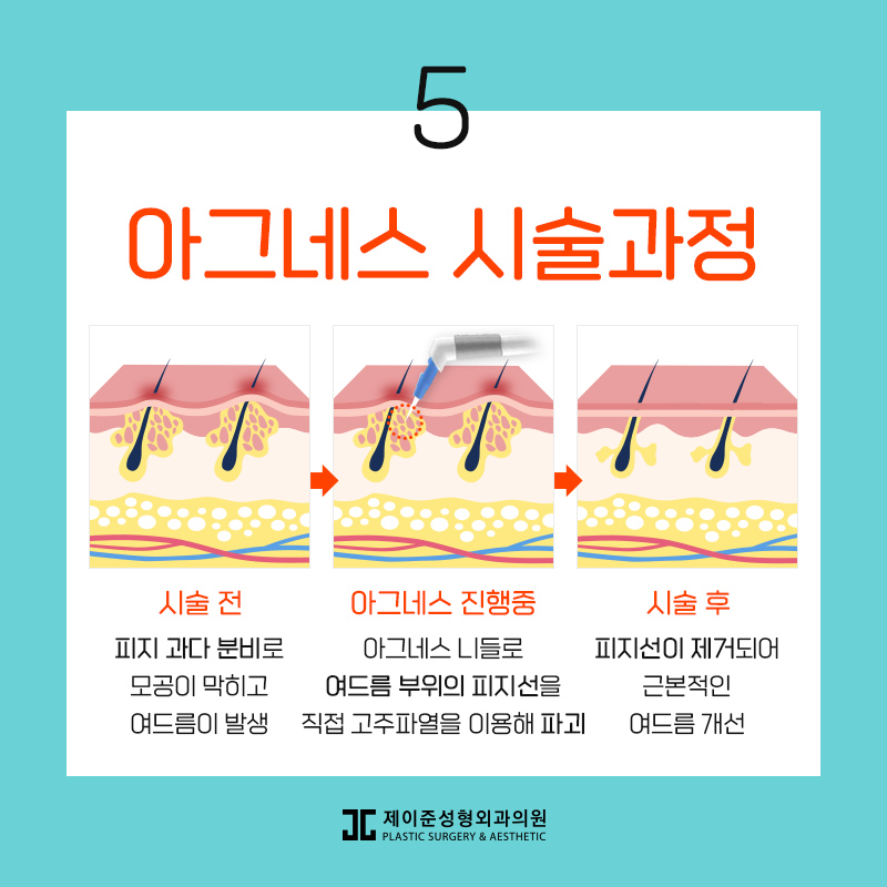 아그네스 , 여드름을 박멸시키고 싶다면! 관련 이미지 6