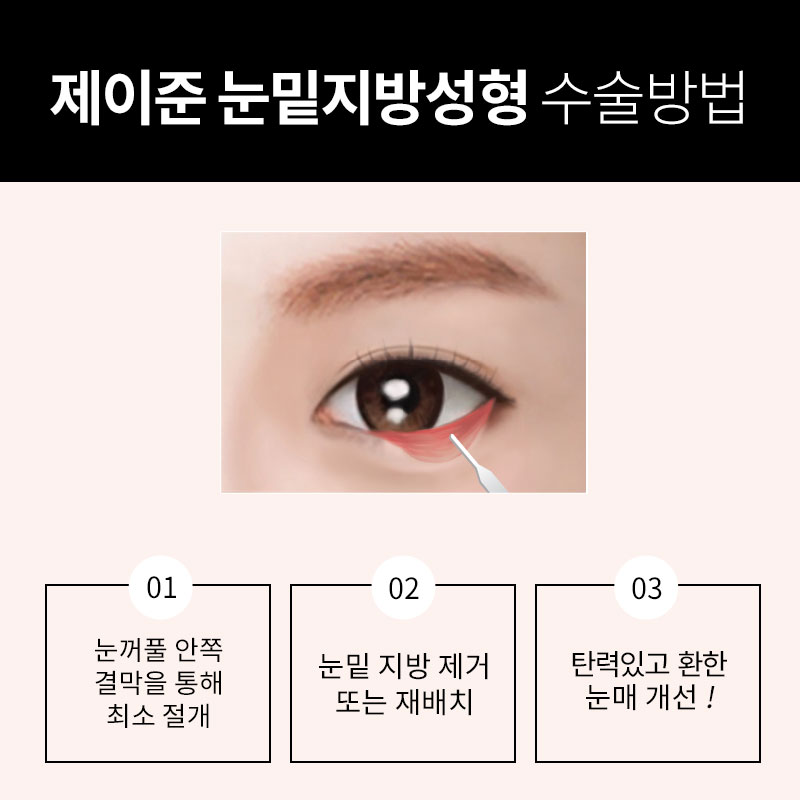 강남눈밑지방제거재배치 │ 관련 이미지 4