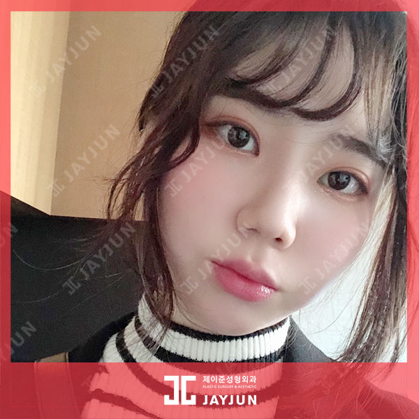 제이준피부과, 강남 입술필러 용량이 무제한이라고?! 관련 이미지 3