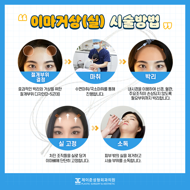 [강남눈성형] 눈성형하러갔는데 이마거상 추천하는 이유 관련 이미지 1