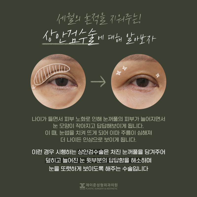 상안검과 하안검이란? 관련 이미지 3