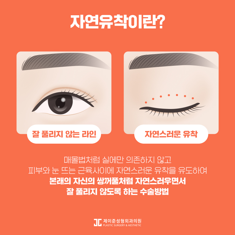 자연스러운 라인을 위한 자연유착 관련 이미지 2