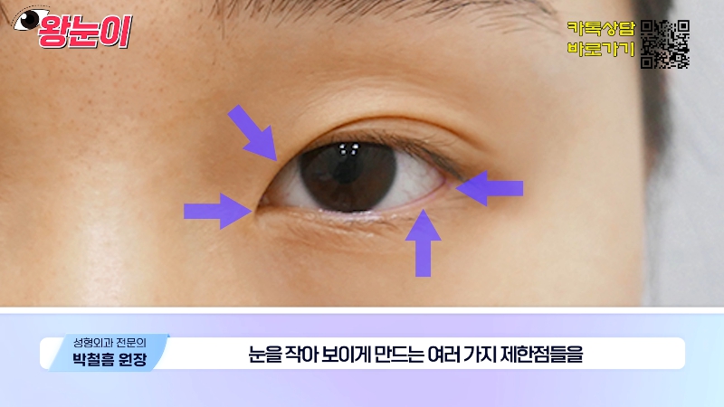 [제이준성형외과&middot;피부과] 제이준성형외과 박철흠 원장님이 알려주는 눈이 커지는 방법 핵심요약! 관련 이미지 36