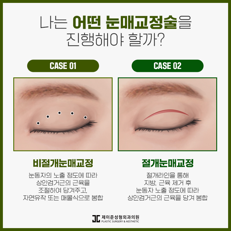 또렷한 눈을 위한 눈매교정 알아보기 관련 이미지 4