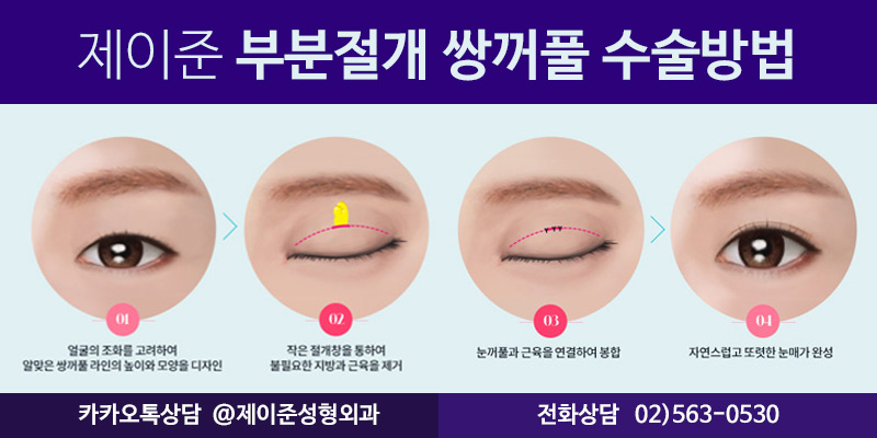 [제이준성형외과] 강남역 쌍수,  자연스러운 변화를 얻으려면? 관련 이미지 5