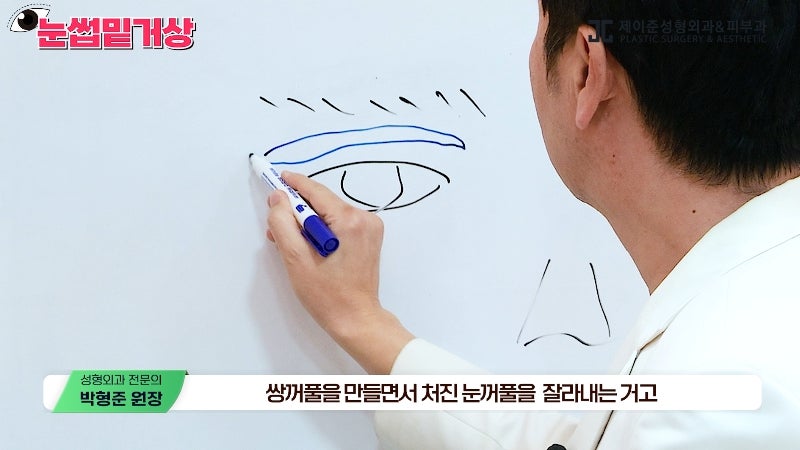 [제이준성형외과&middot;피부과] 쌍꺼풀 라인 변화 없이 눈매 개선은 확실하게! #눈썹밑거상 관련 이미지 8