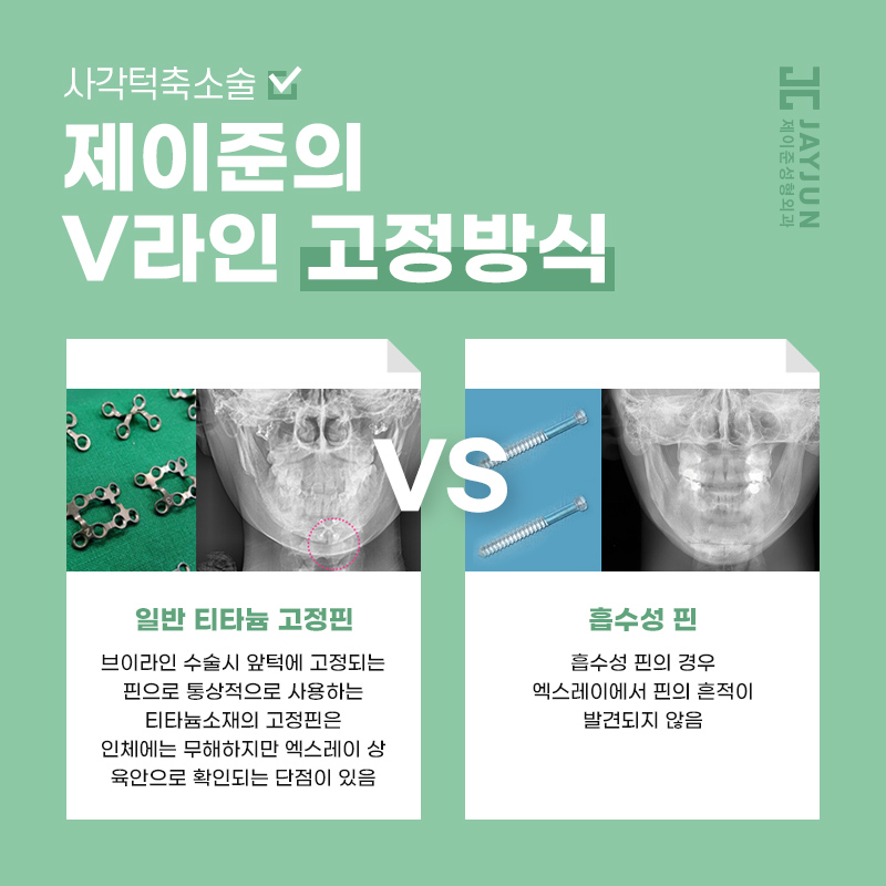 어느 각도에서 봐도 갸름한 얼굴형! 제이준 사각턱축소술 관련 이미지 7