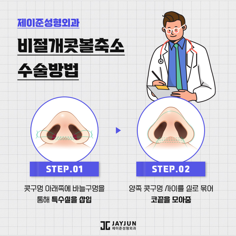 제이준의 비절개콧볼축소 , 콧볼축소 차이점 관련 이미지 5