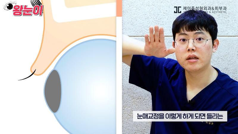 [제이준성형외과&middot;피부과] 제이준성형외과 박철흠 원장님이 알려주는 눈이 커지는 방법 핵심요약! 관련 이미지 12