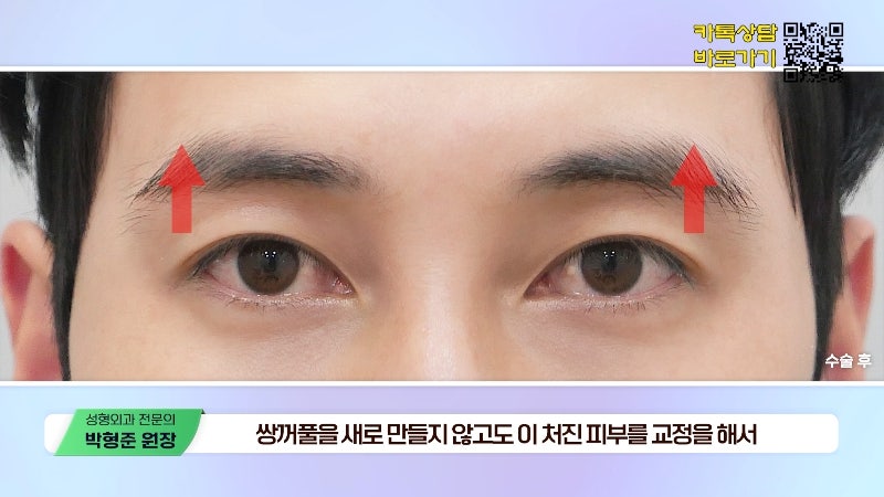 [Jayjun Plastic Surgery & Dermatology] Worried about drooping eyelids? Solve sagging eyes with a brow lift under the eyebrows without double eyelid surgery! image 11
