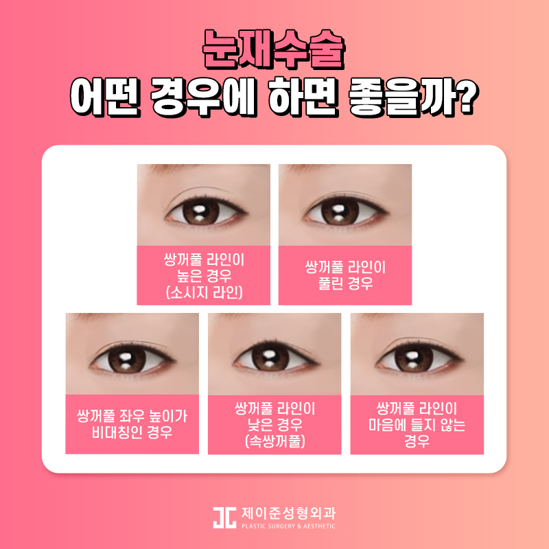 두번의 실패는 없을 제이준성형외과 눈재수술 관련 이미지 4