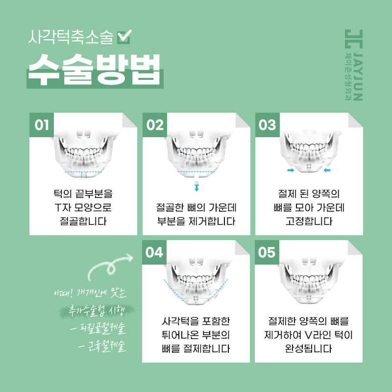 어느 각도에서 봐도 갸름한 얼굴형! 제이준 사각턱축소술 관련 이미지 3