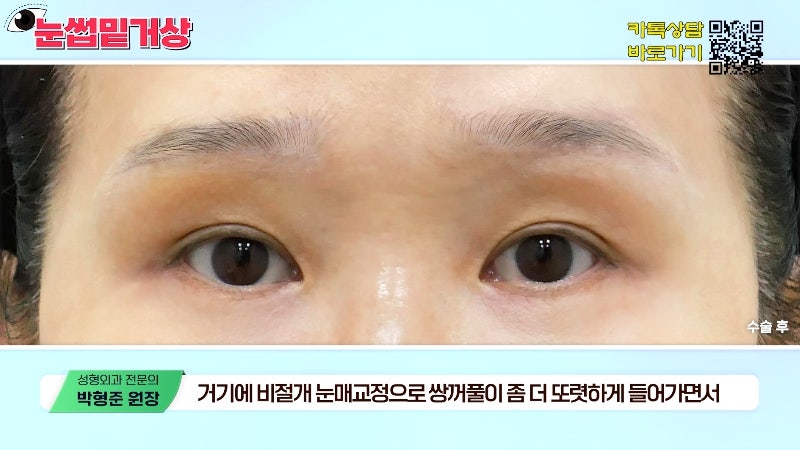 [Jayjun Plastic Surgery & Dermatology] Worried about drooping eyelids? Solve sagging eyes with a brow lift under the eyebrows without double eyelid surgery! image 14