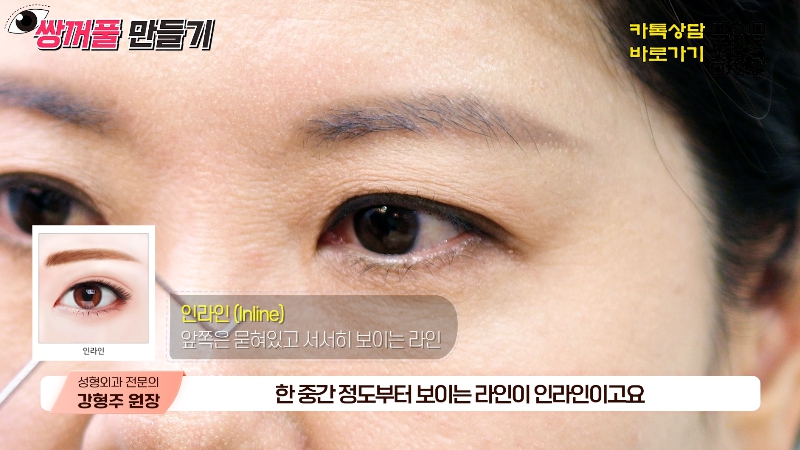 [제이준성형외과&middot;피부과] 내 눈에 찰떡인 쌍꺼풀 라인! 미리 찾아보기👀 관련 이미지 8