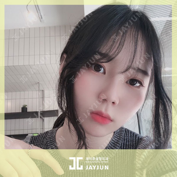 울쎄라 비용 가격 알아보는 방법 관련 이미지 1
